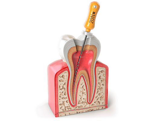 precio de endodoncia en mexicali<br />
