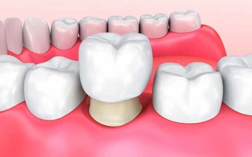 Qué son las coronas dentales y para qué sirven?