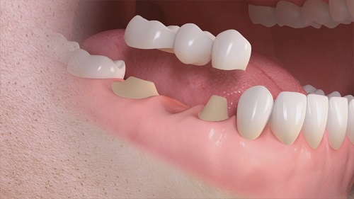 Qué es el puente dental? Funciones y Ventajas